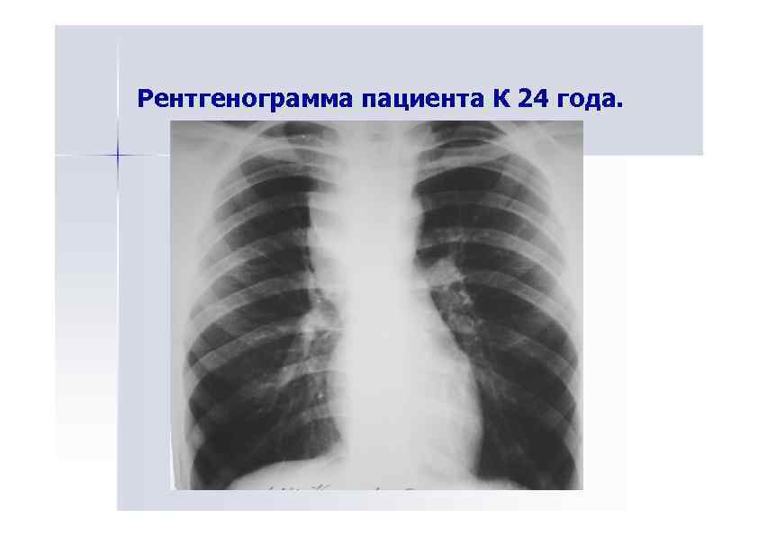 Рентгенограмма пациента К 24 года. 