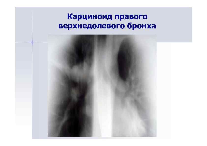 Карциноид правого верхнедолевого бронха 