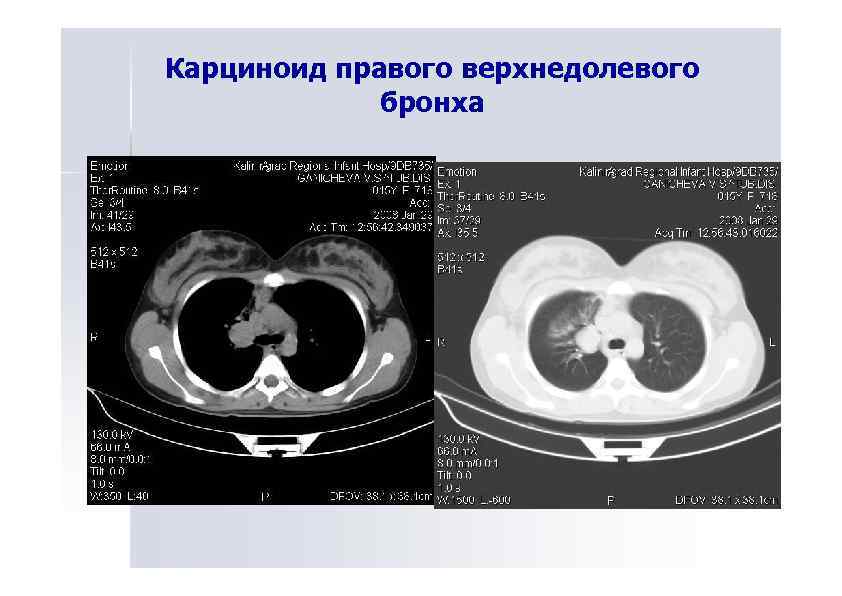 Карциноид правого верхнедолевого бронха 