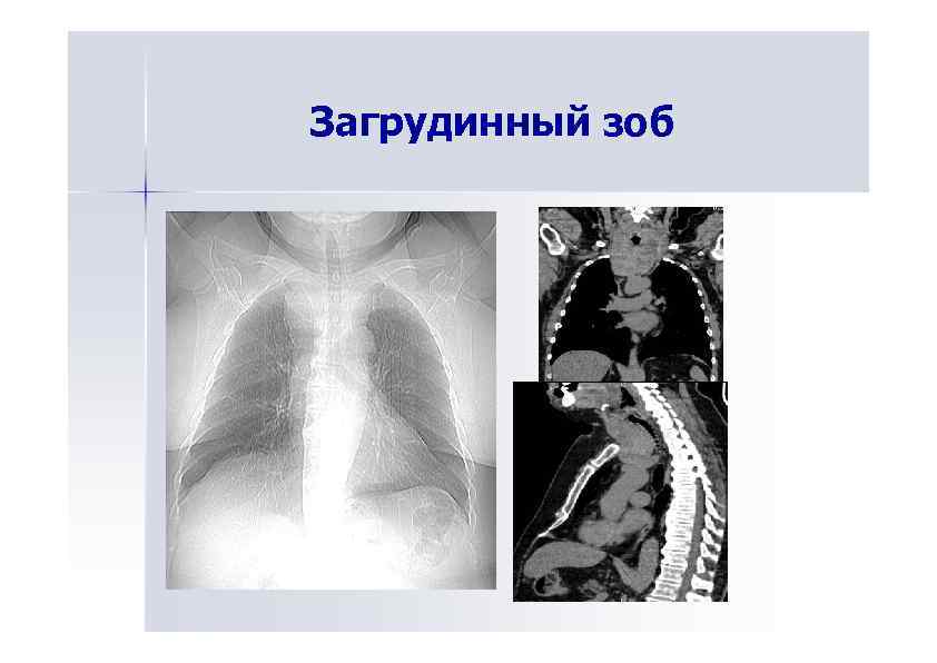 Где находится загрудинный зоб фото