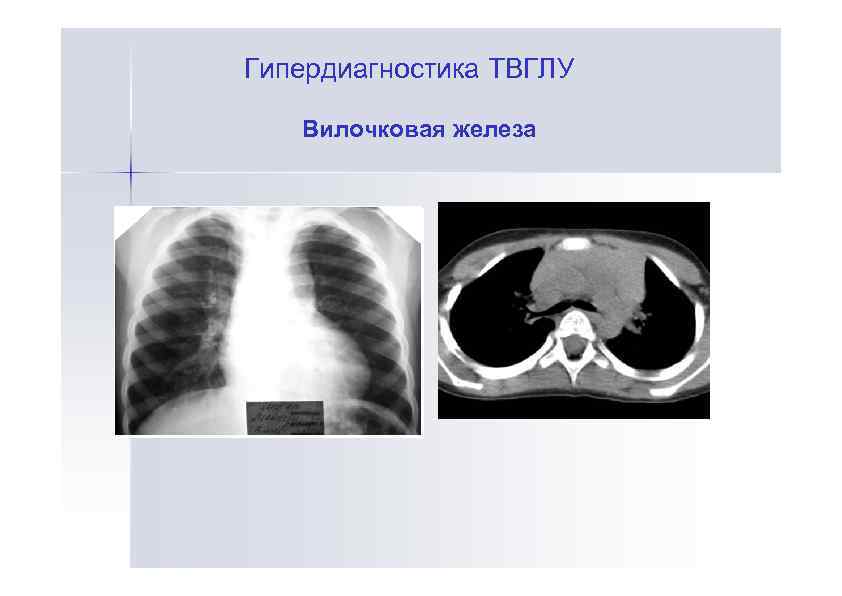 Гипердиагностика ТВГЛУ Вилочковая железа 