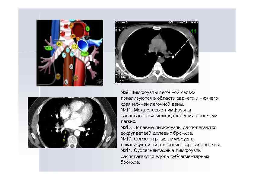 11 № 9. Лимфоузлы легочной связки локализуются в области заднего и нижнего края нижней