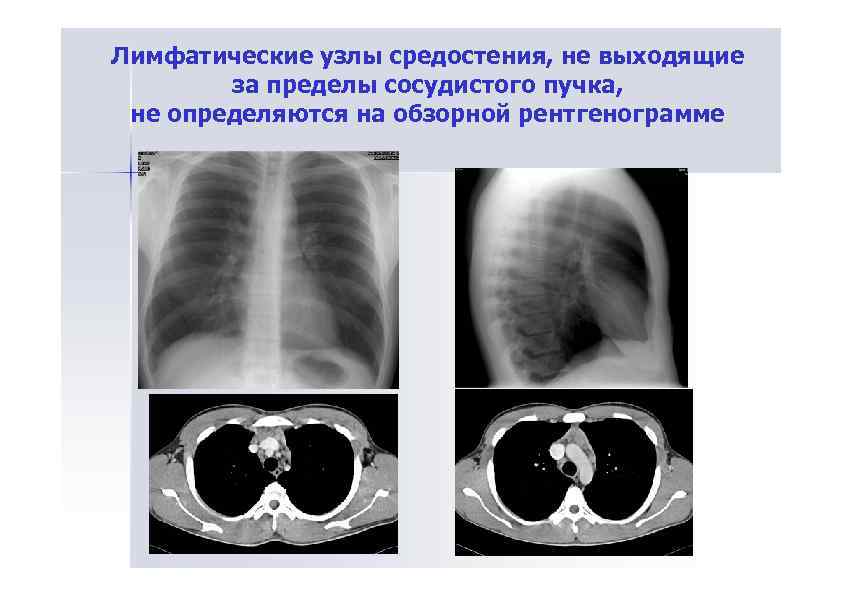 На кт увеличены лимфоузлы. Лимфаденопатия средостения кт. Кт увеличенные лимфатические узлы средостения. Лимфоузлы средостения кт. Группы внутригрудных лимфатических узлов на кт.