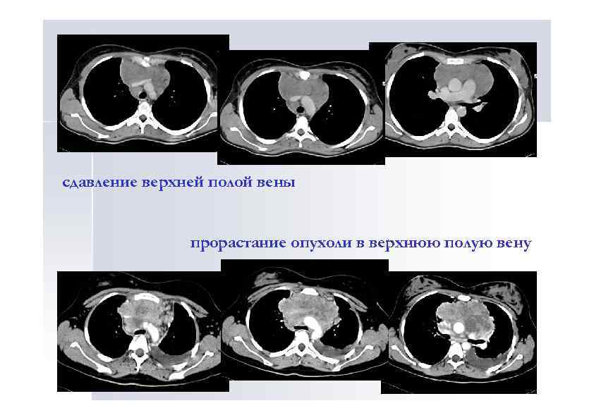 сдавление верхней полой вены прорастание опухоли в верхнюю полую вену 