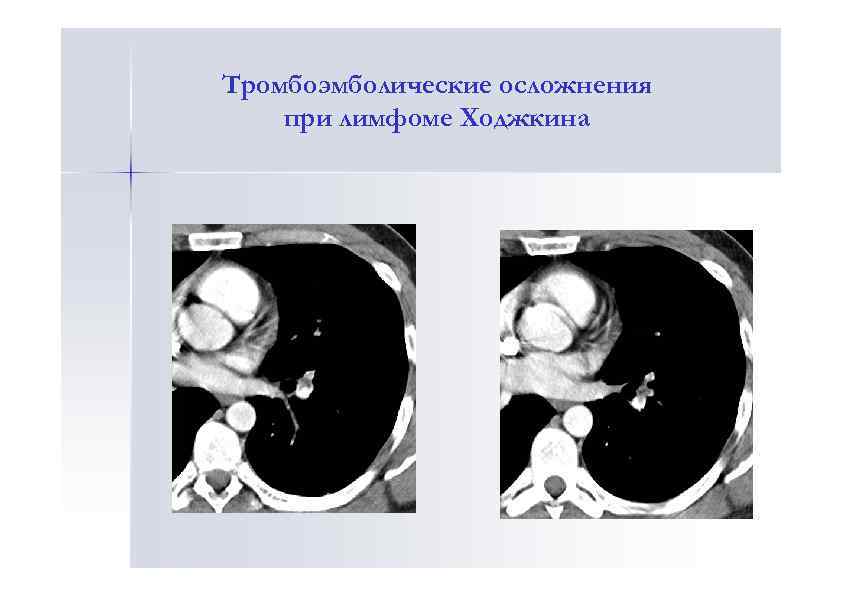 Тромбоэмболические осложнения при лимфоме Ходжкина 