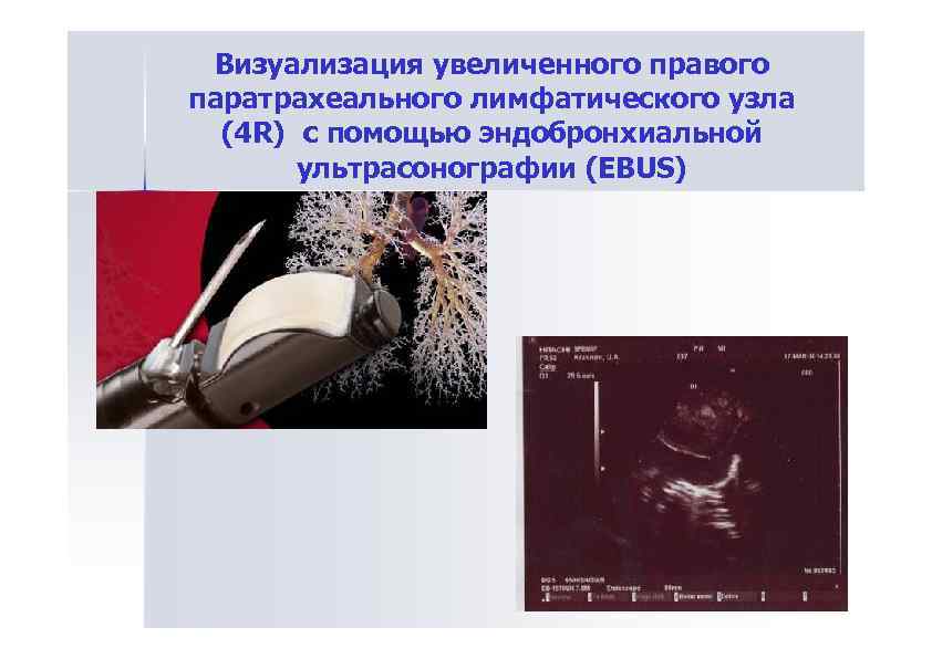 Визуализация увеличенного правого паратрахеального лимфатического узла (4 R) с помощью эндобронхиальной ультрасонографии (EBUS) 