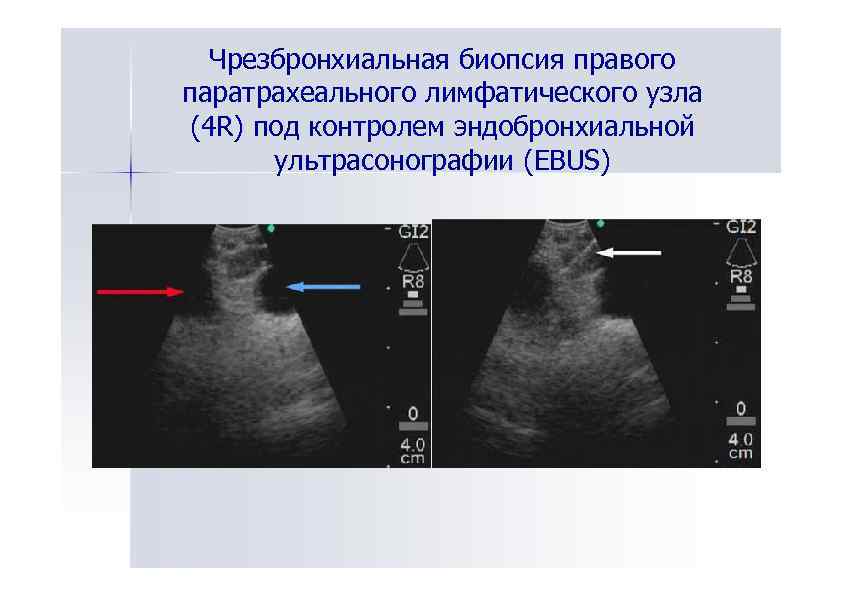 Чрезбронхиальная биопсия правого паратрахеального лимфатического узла (4 R) под контролем эндобронхиальной ультрасонографии (EBUS) 