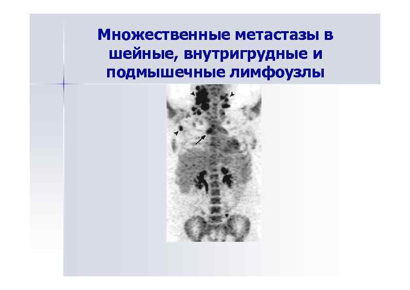 Метастазы шейных лимфоузлов. Метастазы внутригрудных лимфоузлов кт. Множественные метастазы. Множественные лимфоузлы. Метастатическое поражение внутригрудных лимфатических узлов.