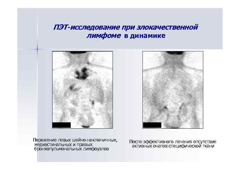 ПЭТ-исследование при злокачественной лимфоме в динамике Поражение левых шейно-наключичных, медиастинальных и правых бронхопульмональных лимфоузлов