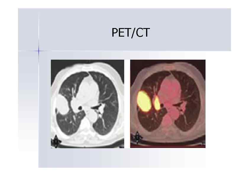 PET/CT 