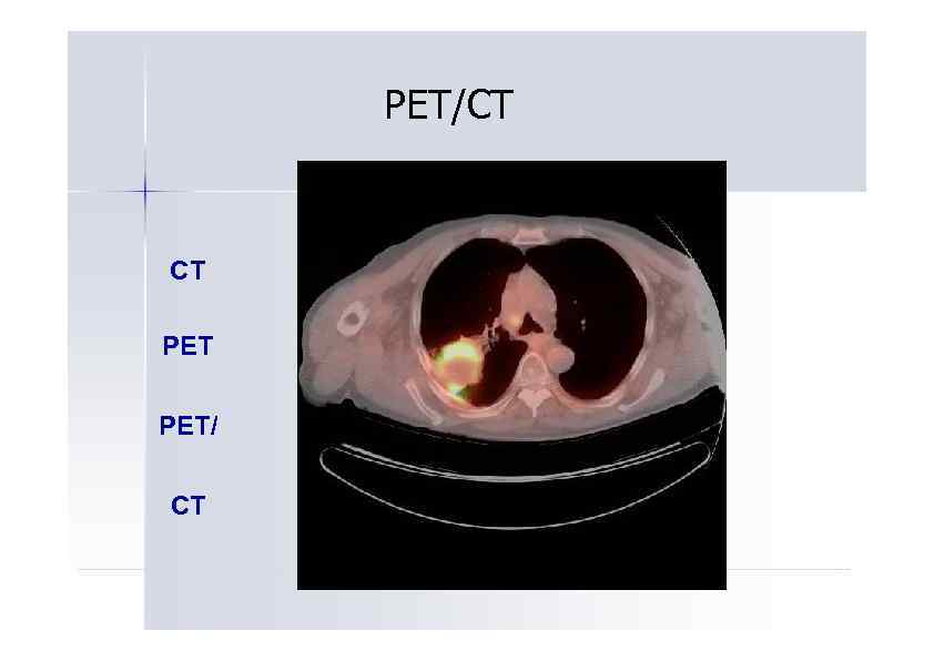 PET/CT CT PET/ CT 