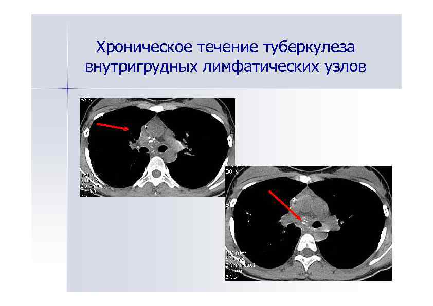 Туберкулез внутригрудных лимфатических узлов презентация