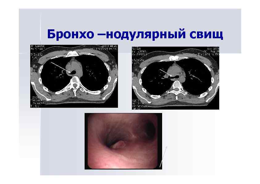 Бронхо –нодулярный свищ 