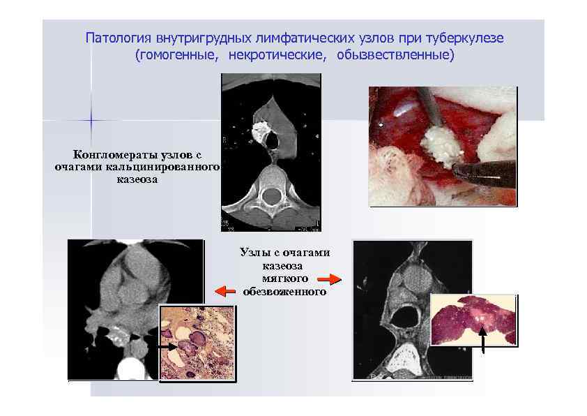 Патология внутригрудных лимфатических узлов при туберкулезе (гомогенные, некротические, обызвествленные) Конгломераты узлов с очагами кальцинированного
