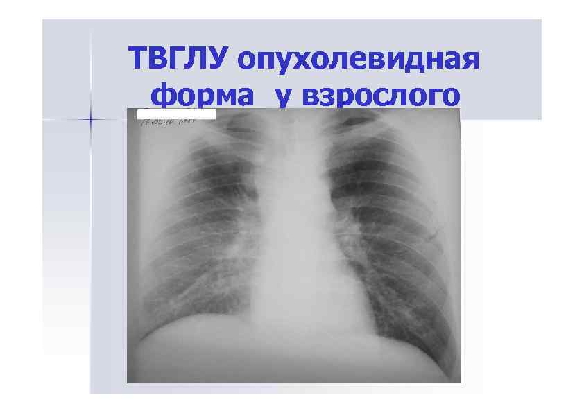 ТВГЛУ опухолевидная форма у взрослого 