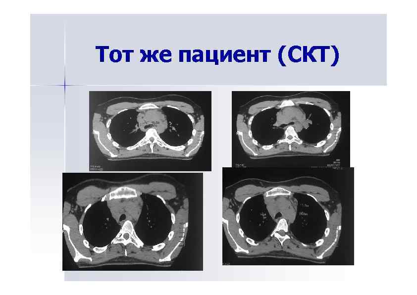 Тот же пациент (СКТ) 