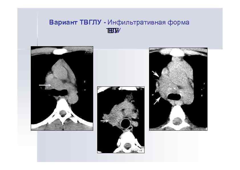 Вариант ТВГЛУ - Инфильтративная форма ТГ У ТВЛ ВГ У Л 