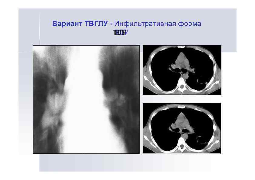 Вариант ТВГЛУ - Инфильтративная форма ТГ У ТВЛ ВГ У Л 