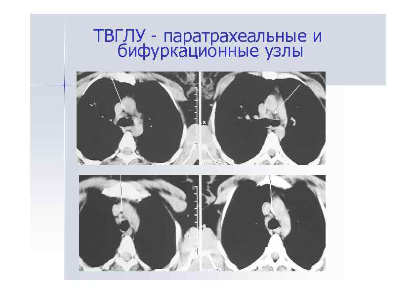 ТВГЛУ - паратрахеальные и бифуркационные узлы 