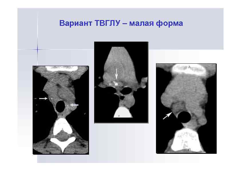 Вариант ТВГЛУ – малая форма 