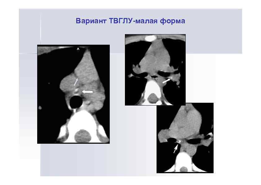 Вариант ТВГЛУ-малая форма 