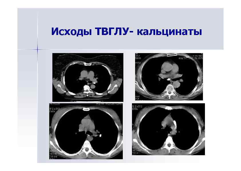 Исходы ТВГЛУ- кальцинаты 