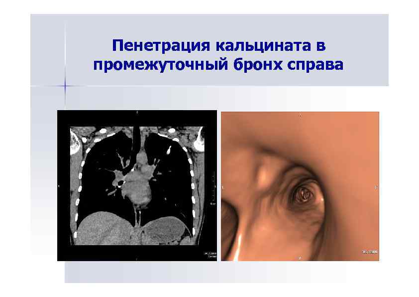Пенетрация кальцината в промежуточный бронх справа 