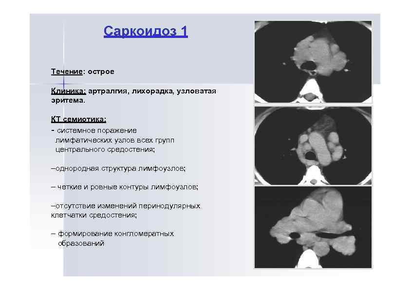 Саркоидоз 1 Течение: острое Клиника: артралгия, лихорадка, узловатая эритема. КТ семиотика: - системное поражение