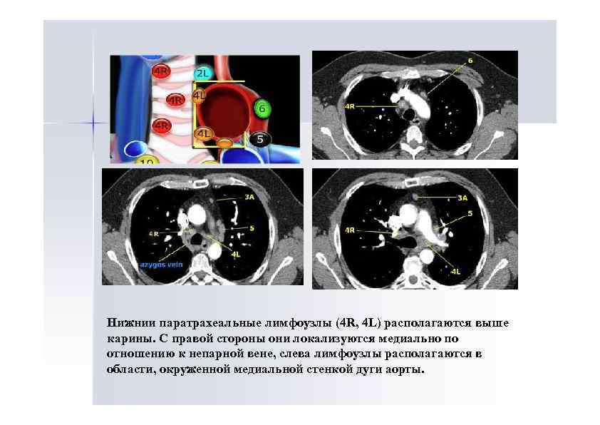 Лимфоузлы средостения схема расположения