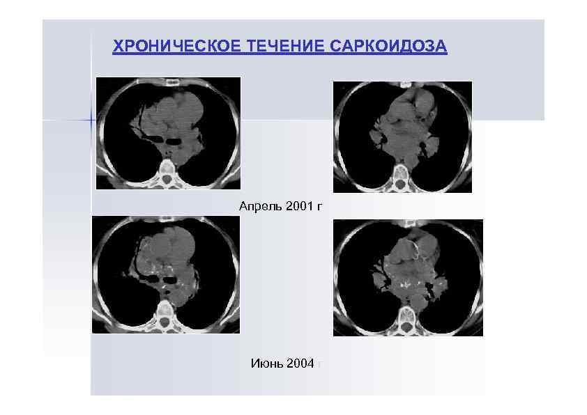 ХРОНИЧЕСКОЕ ТЕЧЕНИЕ САРКОИДОЗА Апрель 2001 г Июнь 2004 г 