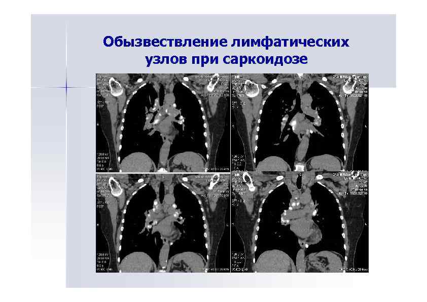 Обызвествление. Обызвествление внутригрудных лимфоузлов. Обызвествление лимфоузлов средостения на кт. Кальциноз внутригрудных лимфоузлов. Обызвествление внутригрудных лимфоузлов рентген.