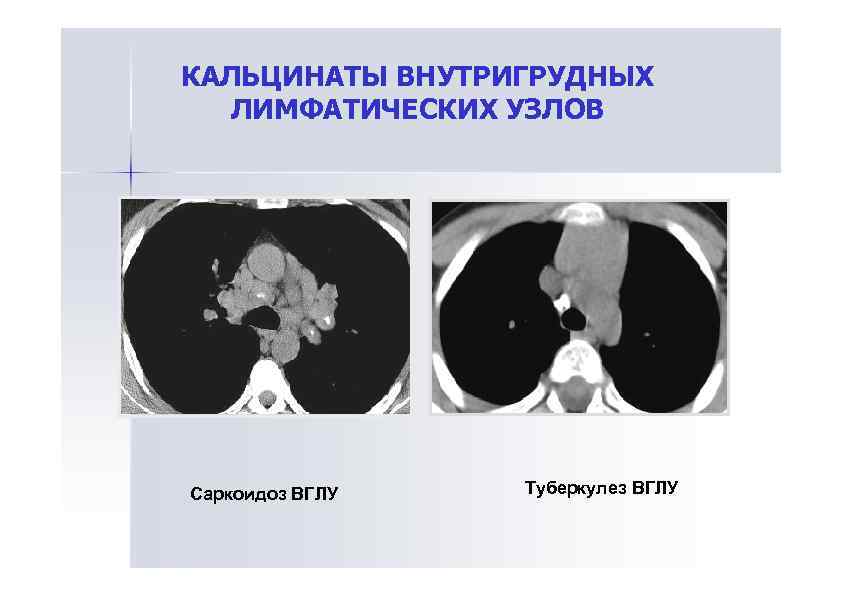 Внутригрудные лимфатические узлы