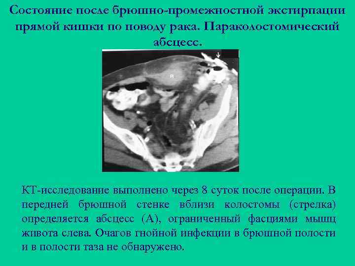 Состояние после брюшно-промежностной экстирпации прямой кишки по поводу рака. Параколостомический абсцесс. КТ-исследование выполнено через