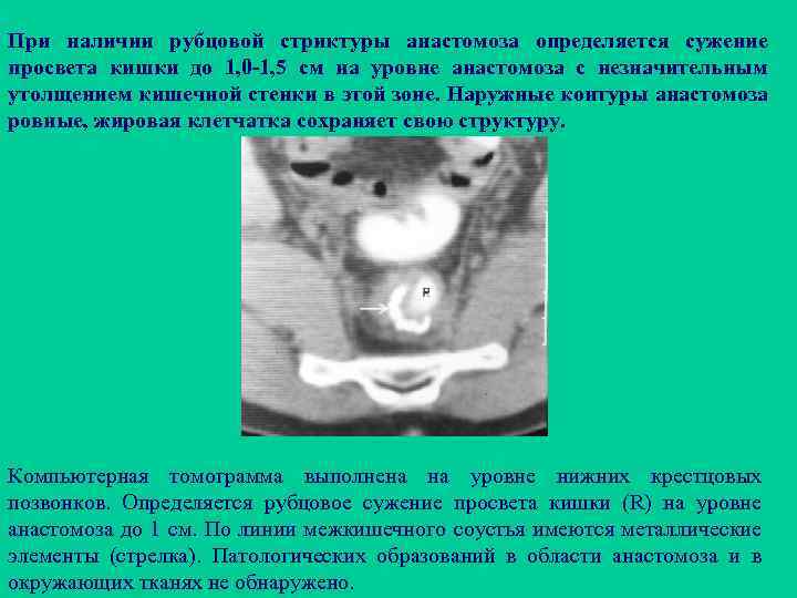 При наличии рубцовой стриктуры анастомоза определяется сужение просвета кишки до 1, 0 -1, 5