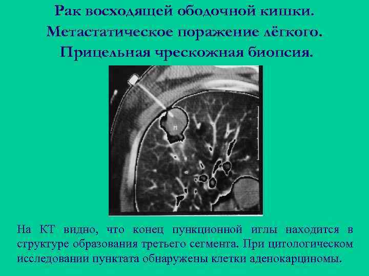 Рак восходящей ободочной кишки. Метастатическое поражение лёгкого. Прицельная чрескожная биопсия. На КТ видно, что