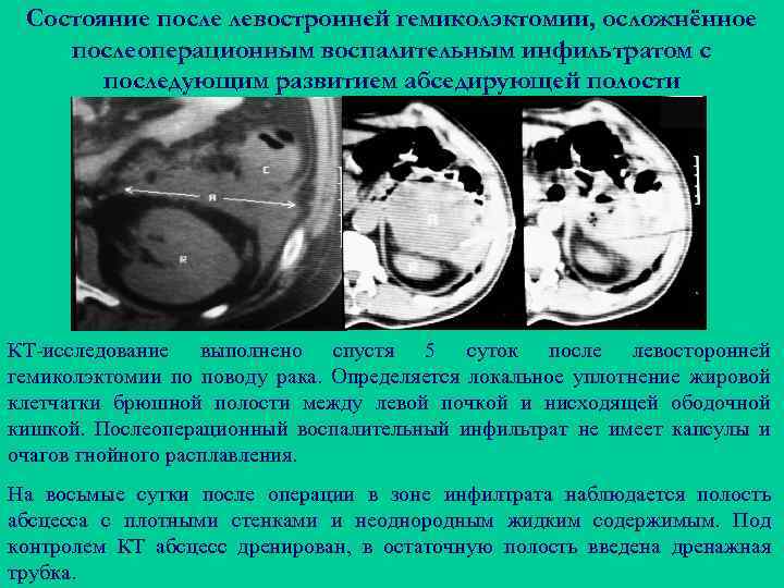 Состояние после левостронней гемиколэктомии, осложнённое послеоперационным воспалительным инфильтратом с последующим развитием абседирующей полости КТ-исследование
