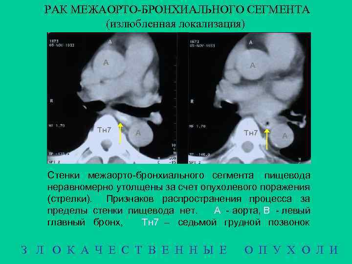РАК МЕЖАОРТО-БРОНХИАЛЬНОГО СЕГМЕНТА (излюбленная локализация) А А B Тн 7 B А Тн 7