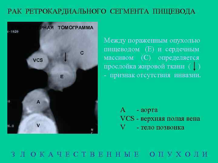 РАК РЕТРОКАРДИАЛЬНОГО СЕГМЕНТА ПИЩЕВОДА КОМПЬЮТЕРНАЯ ТОМОГРАММА С VCS Е Между пораженным опухолью пищеводом (Е)
