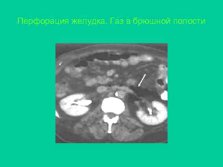Перфорация желудка. Газ в брюшной полости 
