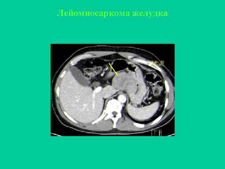 Лейомиосаркома желудка 