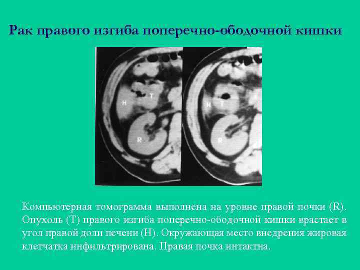 Рак правого изгиба поперечно-ободочной кишки Компьютерная томограмма выполнена на уровне правой почки (R). Опухоль