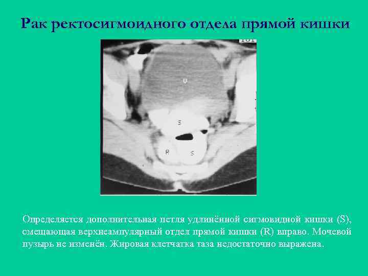 Рак ректосигмоидного отдела прямой кишки Определяется дополнительная петля удлинённой сигмовидной кишки (S), смещающая верхнеампулярный