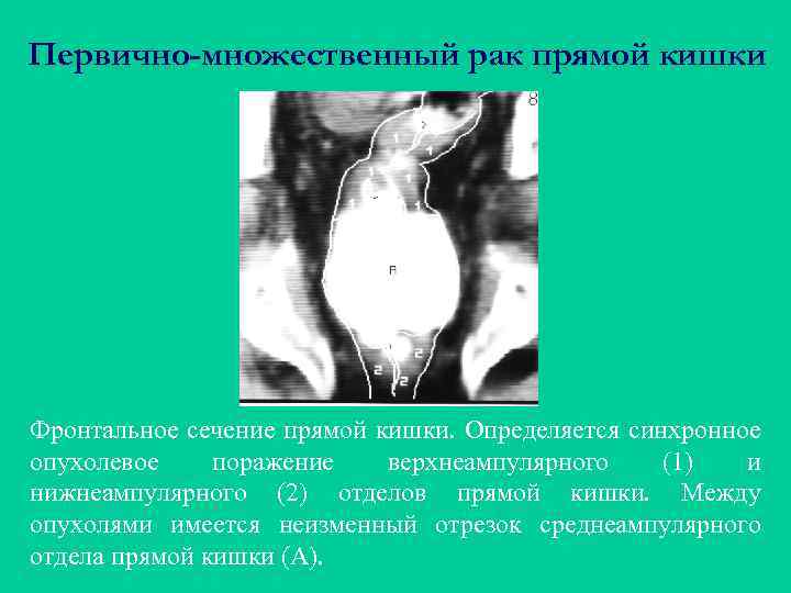 Первично-множественный рак прямой кишки Фронтальное сечение прямой кишки. Определяется синхронное опухолевое поражение верхнеампулярного (1)