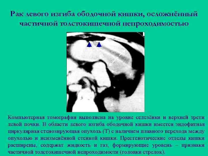 Рак левого изгиба ободочной кишки, осложнённый частичной толстокишечной непроходимостью Компьютерная томография выполнена на уровне