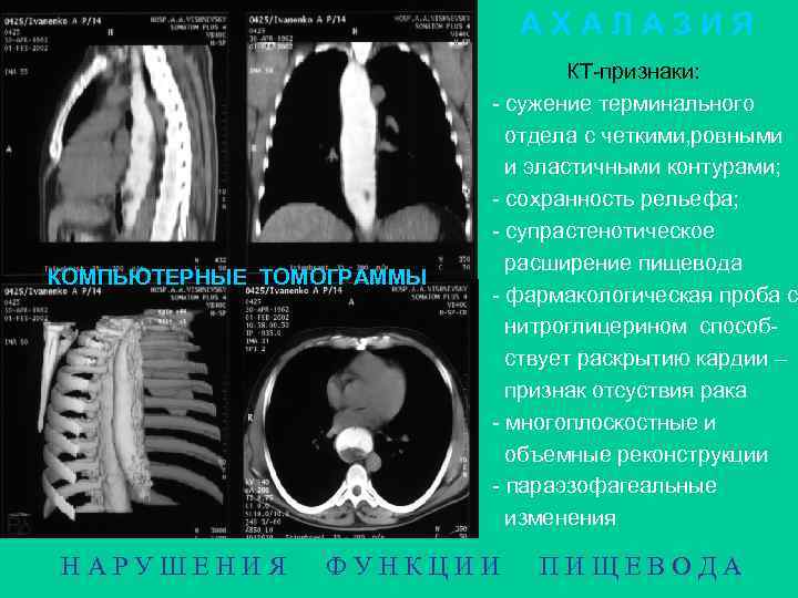 А Х А Л АЗ И Я АХАЛАЗИЯ КОМПЬЮТЕРНЫЕ ТОМОГРАММЫ НАРУШЕНИЯ КТ-признаки: - сужение