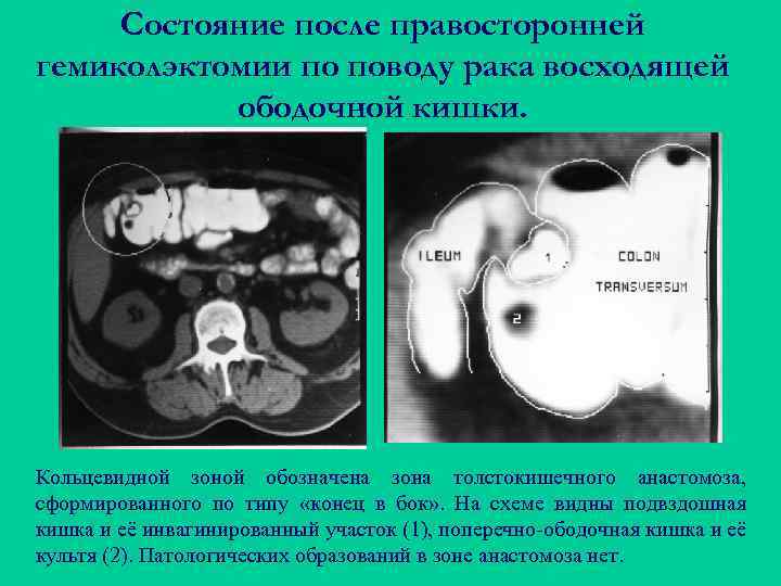 Состояние после правосторонней гемиколэктомии по поводу рака восходящей ободочной кишки. Кольцевидной зоной обозначена зона