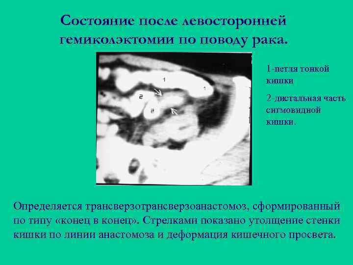 Состояние после левосторонней гемиколэктомии по поводу рака. 1 -петля тонкой кишки 2 -дистальная часть
