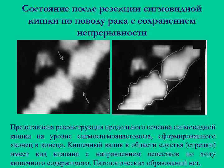 Состояние после резекции сигмовидной кишки по поводу рака с сохранением непрерывности Представлена реконструкция продольного