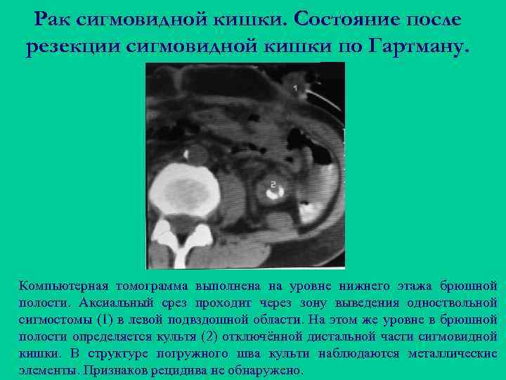 Рак сигмовидной кишки. Состояние после резекции сигмовидной кишки по Гартману. Компьютерная томограмма выполнена на