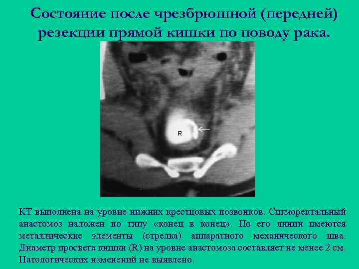 Состояние после чрезбрюшной (передней) резекции прямой кишки по поводу рака. КТ выполнена на уровне